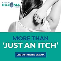 More Than 'Just An Itch': Understanding Eczema