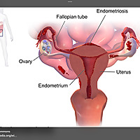 Endometriosis &mdash; A Fresh Look for Everyone