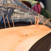 Learn Abdominal Acupuncture