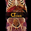 ctisus