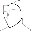 Medikemos Hair Transplantation