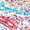 Mesothelioma USA