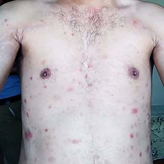 Psoriasis Boy